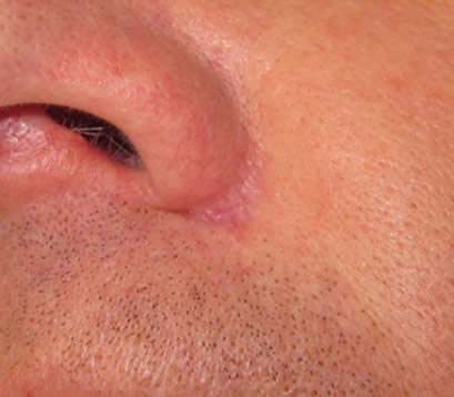 Skin cancer on face near nose after 5 months